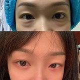 去眼袋后一周不痛不肿