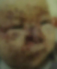3个月大女婴惨遭群鼠啃食脸部!咬伤上百处,右侧鼻子完全咬掉