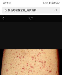 侄儿突发过敏性紫癫,最让人恐怖的是复发性太频繁