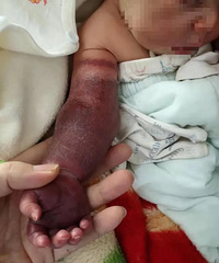 奶奶看衣服袖子太松,在新生儿手臂上扎上松紧带,结果害娃残疾