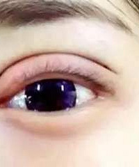 贵阳做双眼皮好的医院,割双眼皮后肉条明显怎么办?