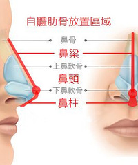 肋软骨隆鼻对身体有影响吗?贵阳隆鼻医院哪家专业