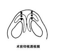 我到贵阳去做隆鼻手术,为什么医生要我延长鼻小柱?