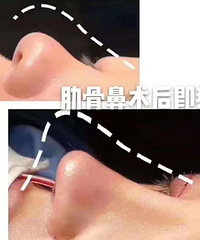 在贵阳做完隆鼻手术可以维持多久?