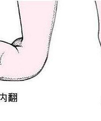 查出肚子里的宝宝是足内翻,舍不得流掉他,想生了以后去做纠正