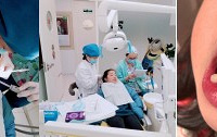 娃儿换了牙齿后长成了这样,医生说得矫正