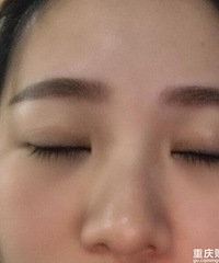 双眼皮修复半年后,真的感觉自己被拯救了
