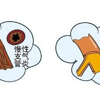 怎么注意支气管炎!一整个冬天,娃儿好了又复发,把人都整疯了