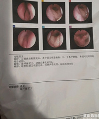 腺样体肥大扁条体肥大鼻炎保守治疗第一天