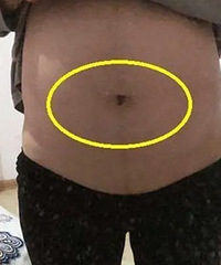 孕妈“凹肚脐”生男孩子?
