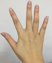 试过多种方法,终于搞定了手上的湿疹