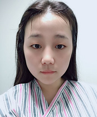 做完双眼皮没有任何变化,有点小后悔了