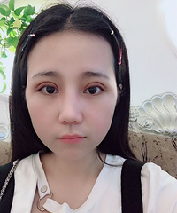 做完双眼皮感觉没有任何变化,朋友却说变成熟了