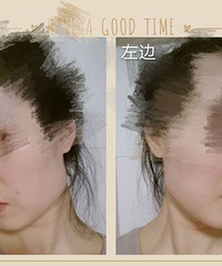打瘦脸针详细记录,2个月后大小脸改变很明显