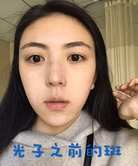 第一次光子祛斑,两周后出门都不用擦粉底液