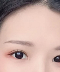 找到个审美在线的医生,做的双眼皮宽度很自然