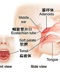 腺样体肥大,保守还是手术?看完这一篇就知道了