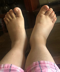 孕期脚肿的宝妈们,用我这个方法,两天消肿【孕期龙门阵】