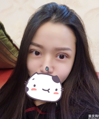 常年贴双眼皮贴眼睛没有神,割了双眼皮后好了很多