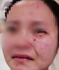 气愤!一外籍确诊者殴打咬伤女护士