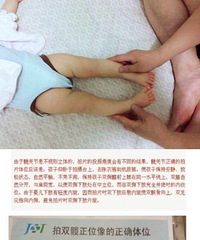 说说我所了解到的髋关节发育不良