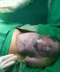 剖腹产宝宝出来的全过程