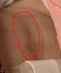剖腹产后伤口恢复得不错