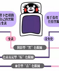 别急着打玻尿酸,先来了解下你的黑眼圈是什么类型
