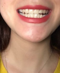 哈哈哈哈哈哈,我的牙齿终于白了!!!