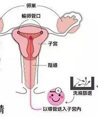 详细的关于人工授精、试管婴儿流程及注意事项,并在线答疑!!!
