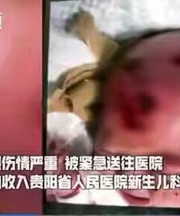 贵阳一3个月大的女婴被老鼠咬成重伤,头皮被啃得露出了头骨