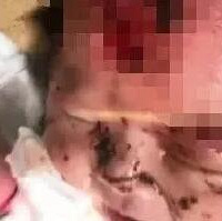 两个月大女婴被动物啃咬露出骨头