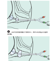 上球囊、人工破水、手剥胎盘,生个孩子经历了一轮又一轮“摧残”