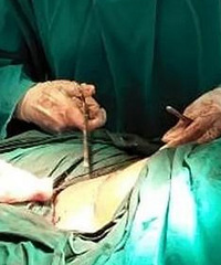 剖腹产并发症好可怕