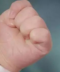 宝宝两岁吃手都吃出老茧了,涂过苦甲水、黄莲水,都没得什么用
