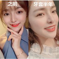 戴牙套半年效果很满意
