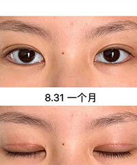 适合脸型的双眼皮更自然,记录5个月恢复情况,你们觉得效果如何