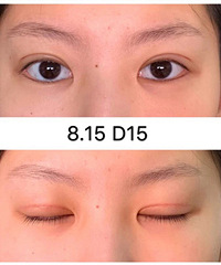 适合脸型的双眼皮更自然,记录5个月恢复情况,你们觉得效果如何