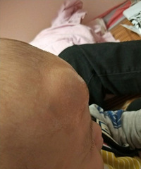宝宝头不小心磕肿了,宝妈知道怎么能快速消肿吗?