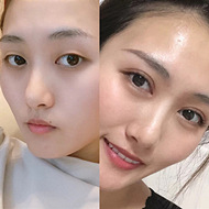 割双眼皮后开始变成熟