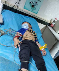 4岁小朋友做扁桃体和腺样体手术经验