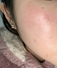 干货!皮肤过敏不用怕 教你一招解决