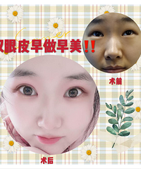 后悔没有早点做双眼皮手术,朋友都说变了个样
