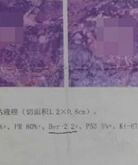 27岁的我因为乳房硬块意外查出乳腺癌,老公看着结果就哭了