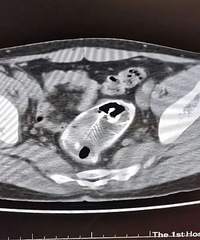 男子腹痛难忍肚子里面居然有条鱼:不小心坐到鱼上