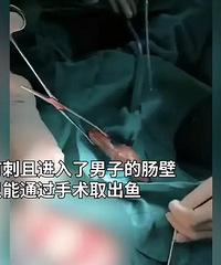 男子腹痛难忍肚子里面居然有条鱼:不小心坐到鱼上