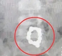心真大,孩子误吞了磁力珠,肚子痛了2个月家长才带去看医生