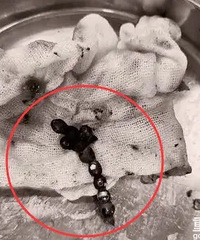 心真大,孩子误吞了磁力珠,肚子痛了2个月家长才带去看医生