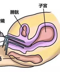 做试管婴儿前为什么要做宫腔镜