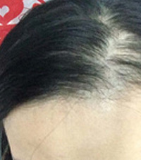 脱发脱到头皮反光,配合中医院的洗头治疗,头发终于长起来了